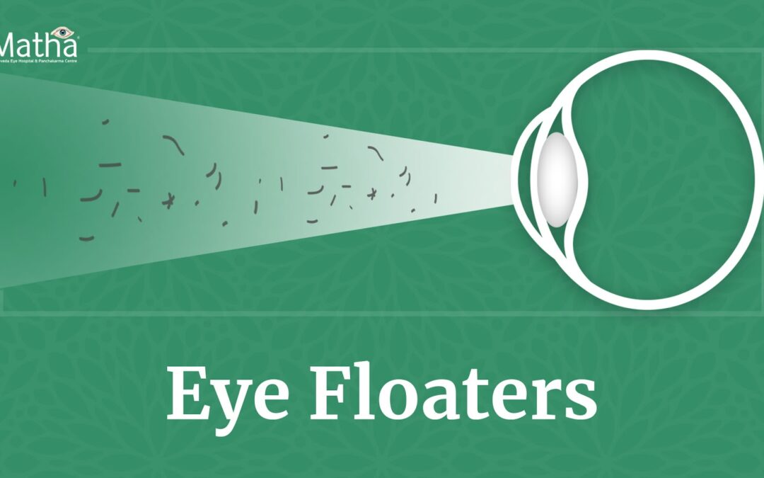 Ayurvedic Treatment for Eye Floaters