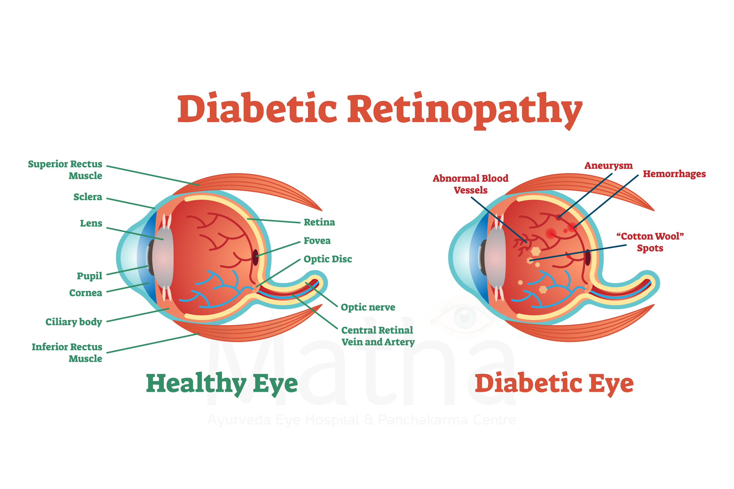 diabetic retinopathy ayurvedic treatment matha