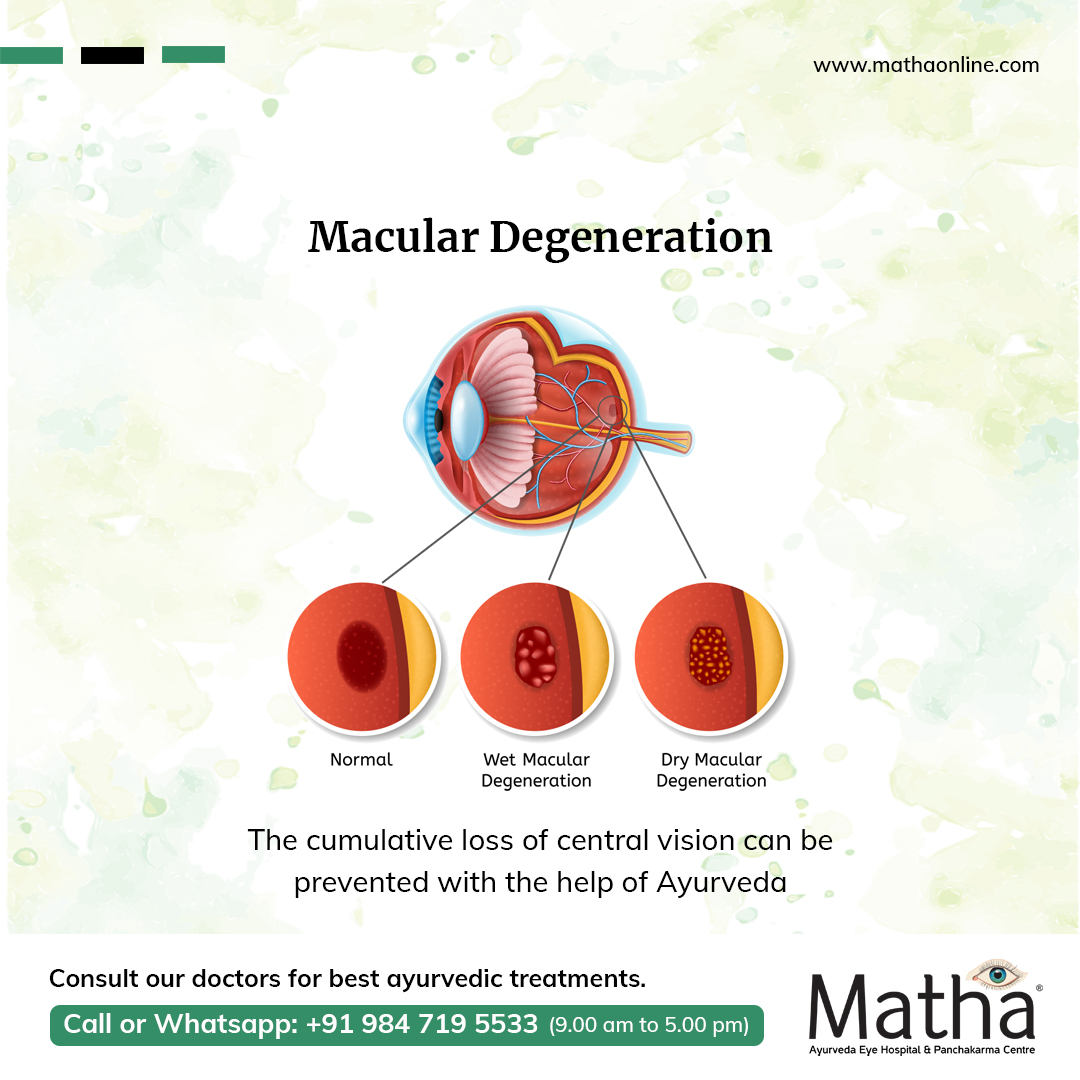 macular degeneration ayurvedic treatment