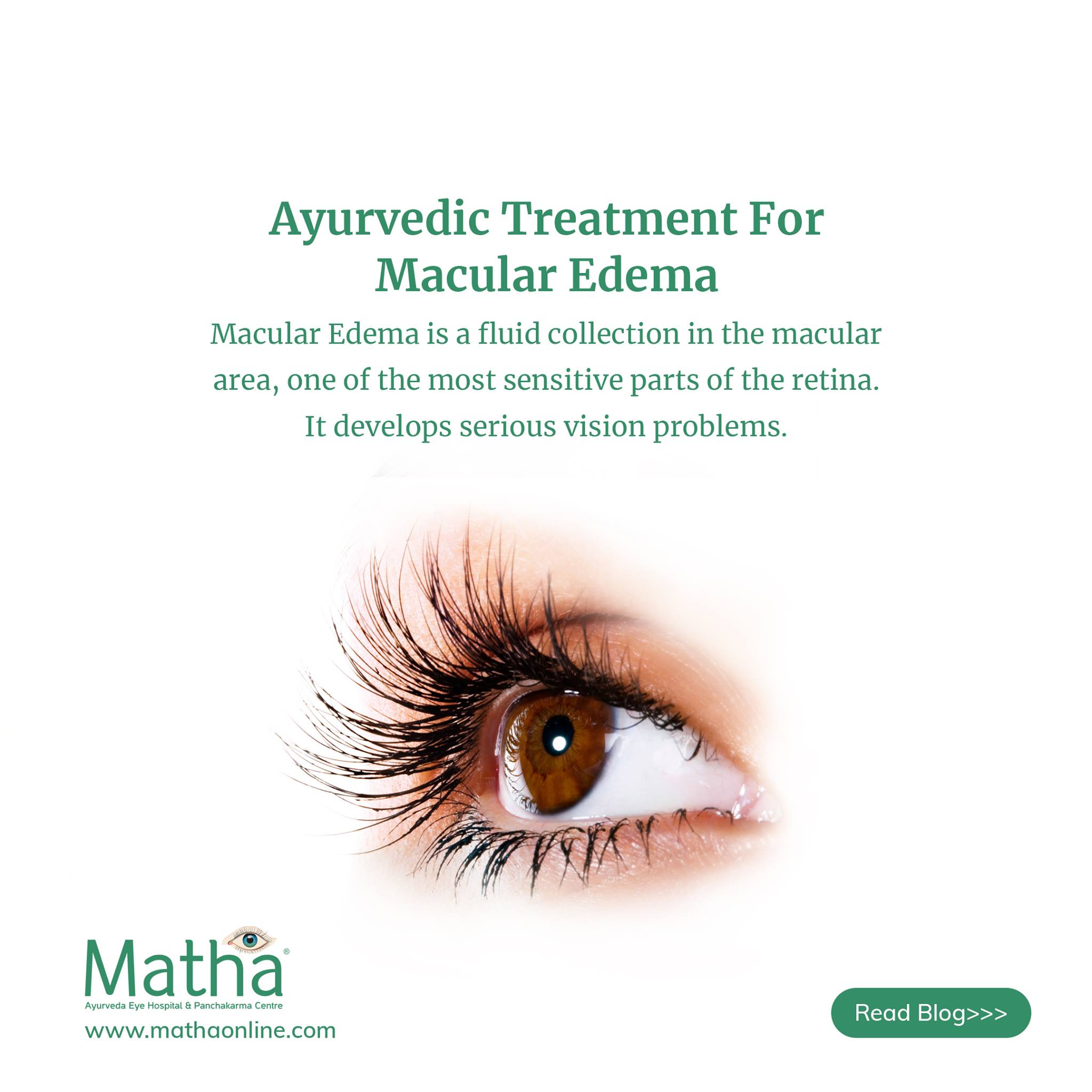 macular edema ayurvedic treatment